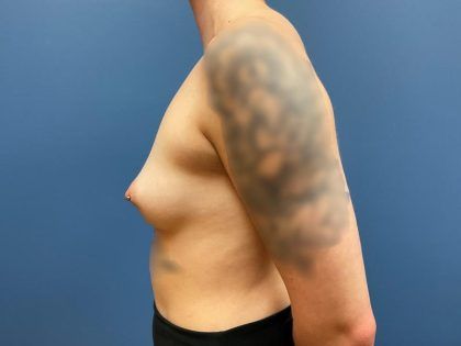 Breast Augmentation Before & After