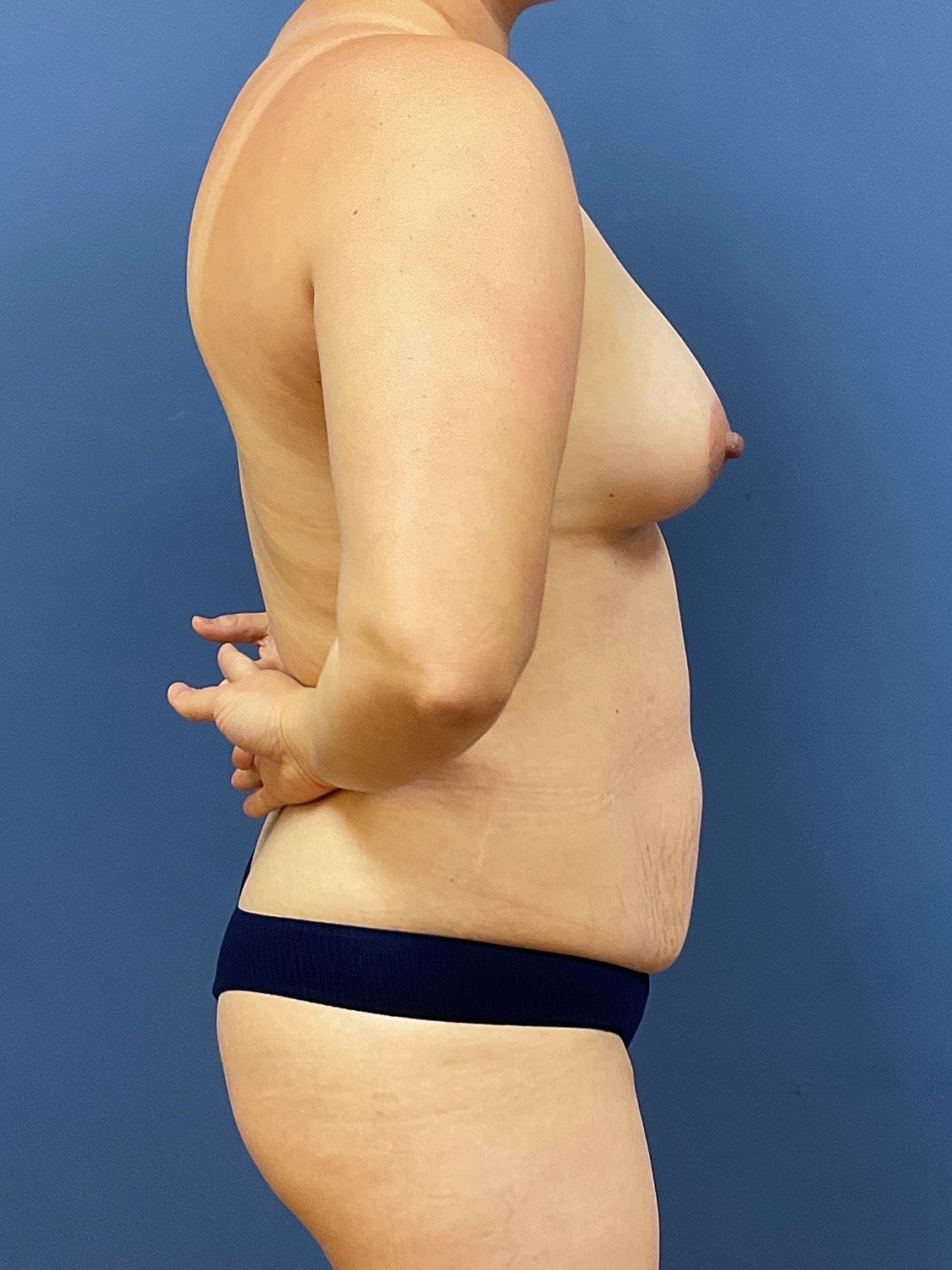 Breast Augmentation Before & After