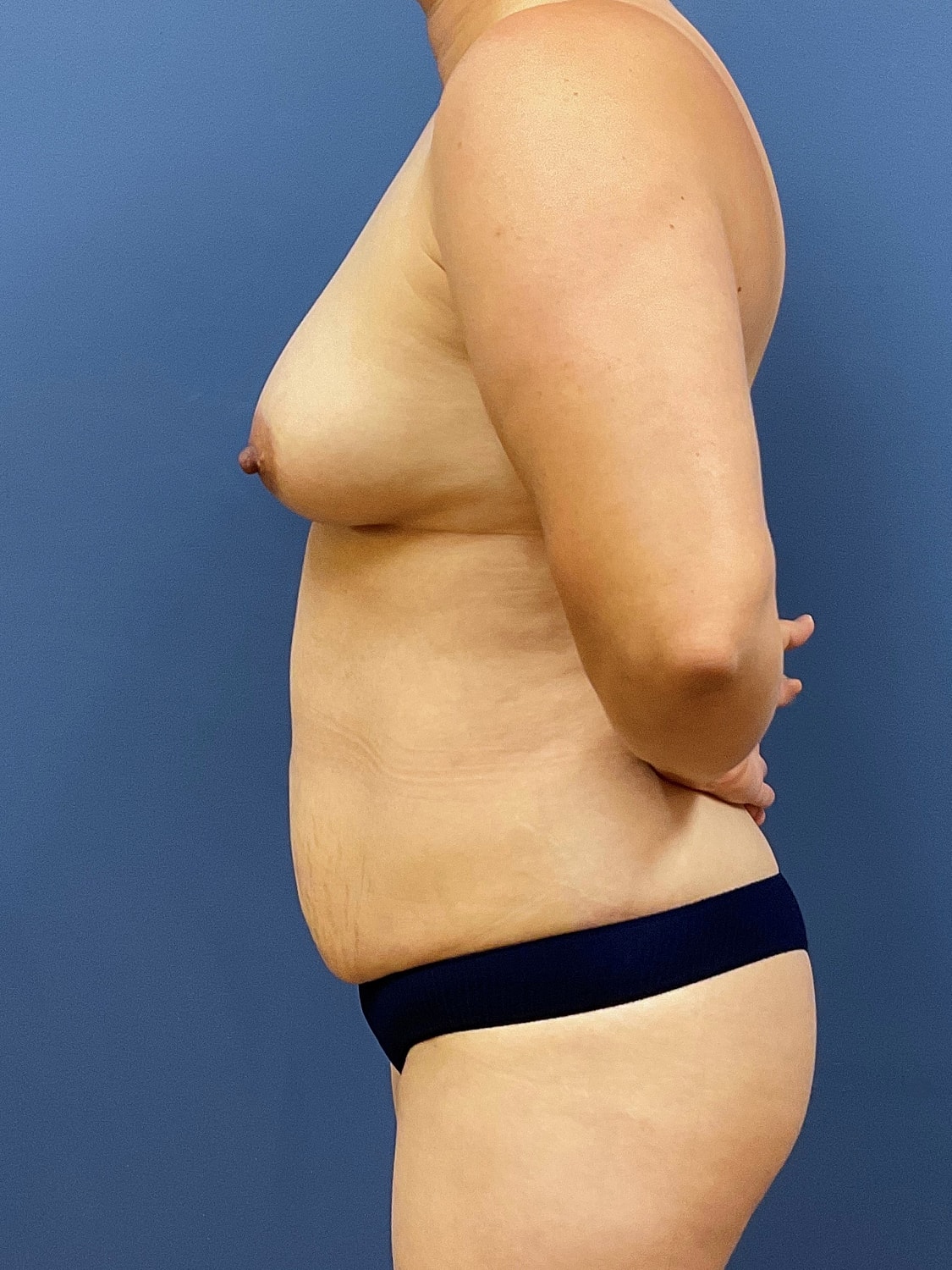 Breast Augmentation Before & After