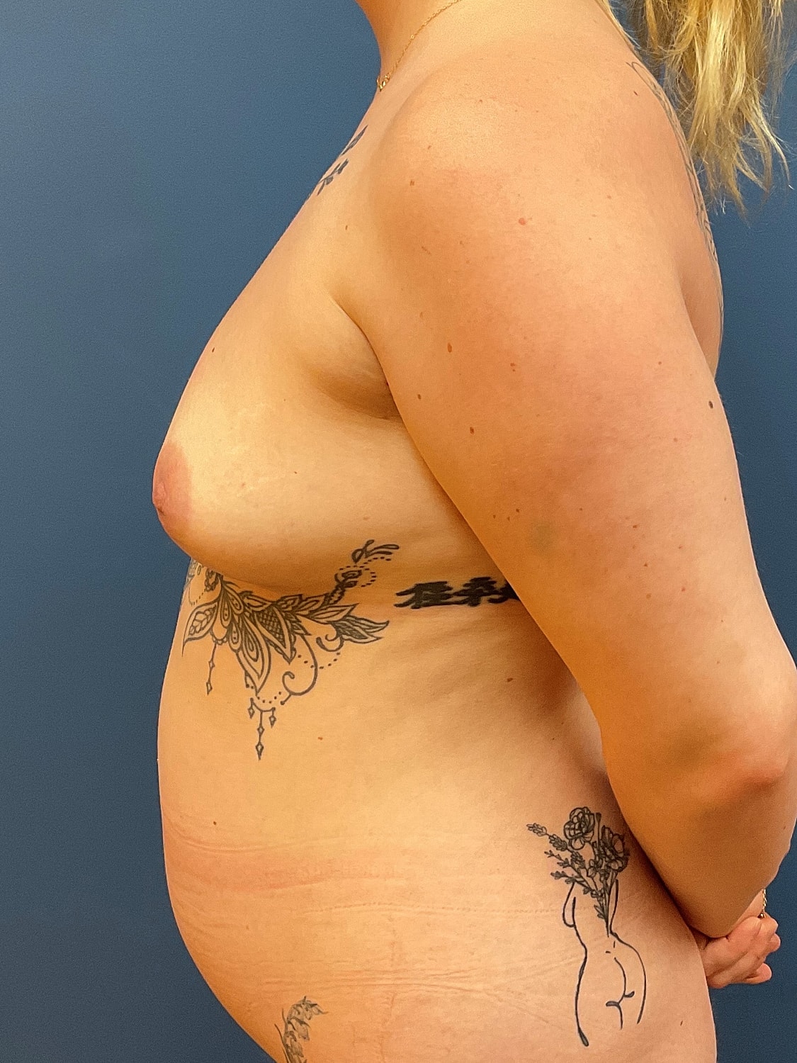 Breast Augmentation Before & After