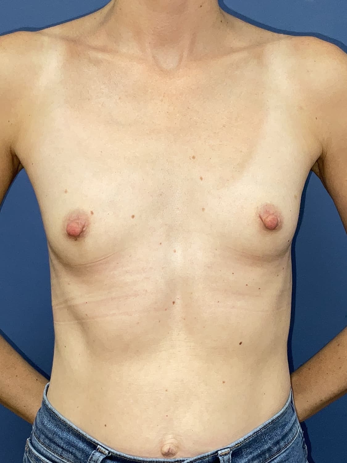 Breast Augmentation Before & After