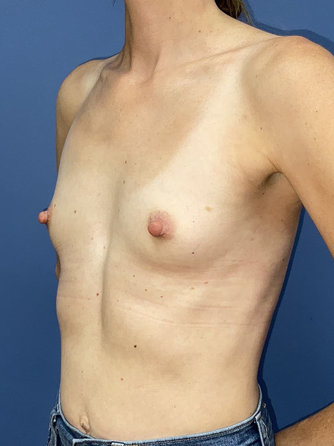 Breast Augmentation Before & After