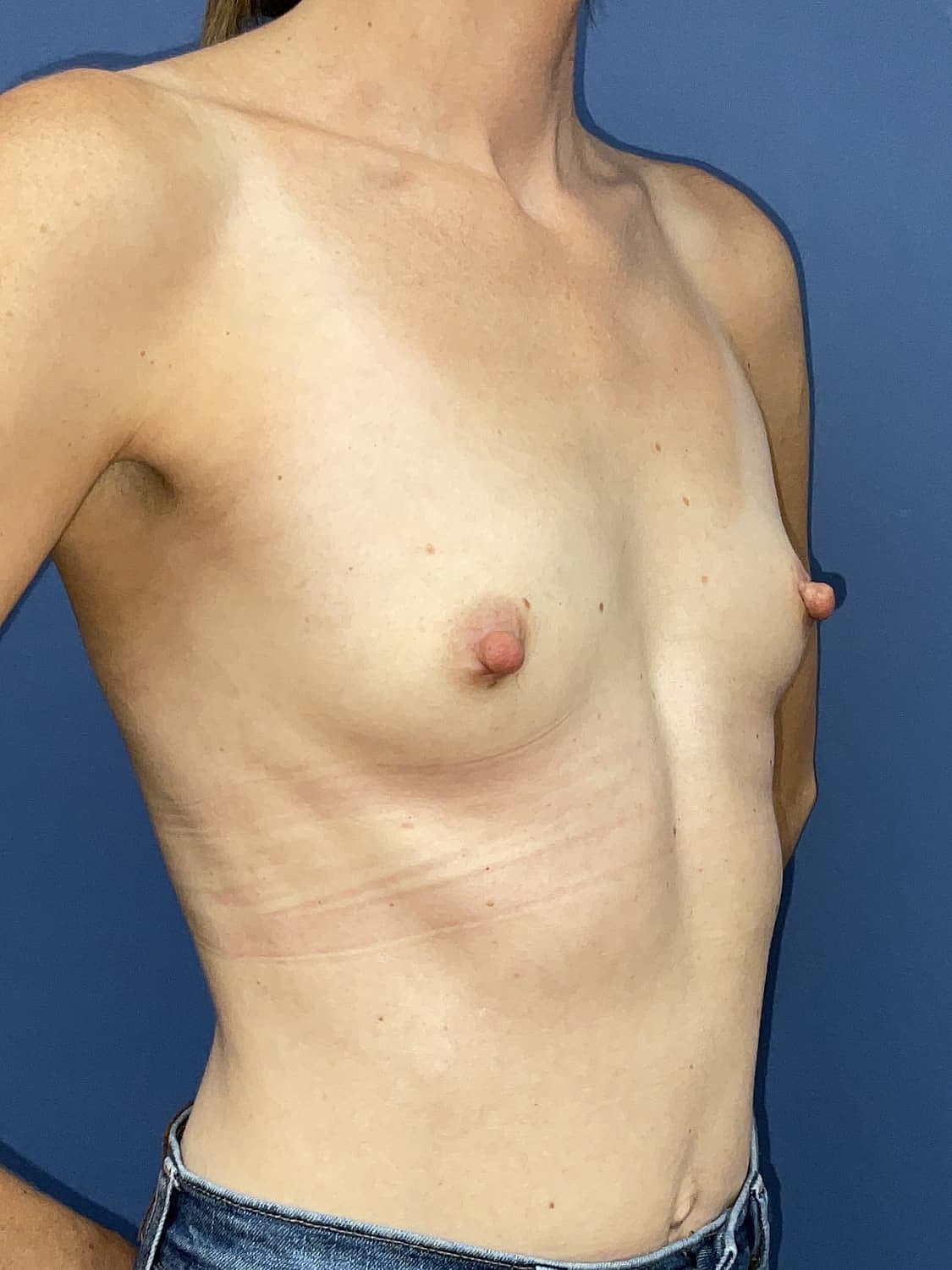 Breast Augmentation Before & After