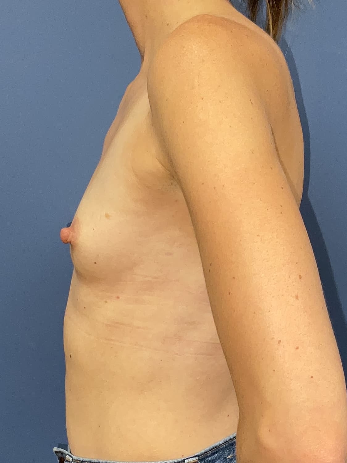 Breast Augmentation Before & After