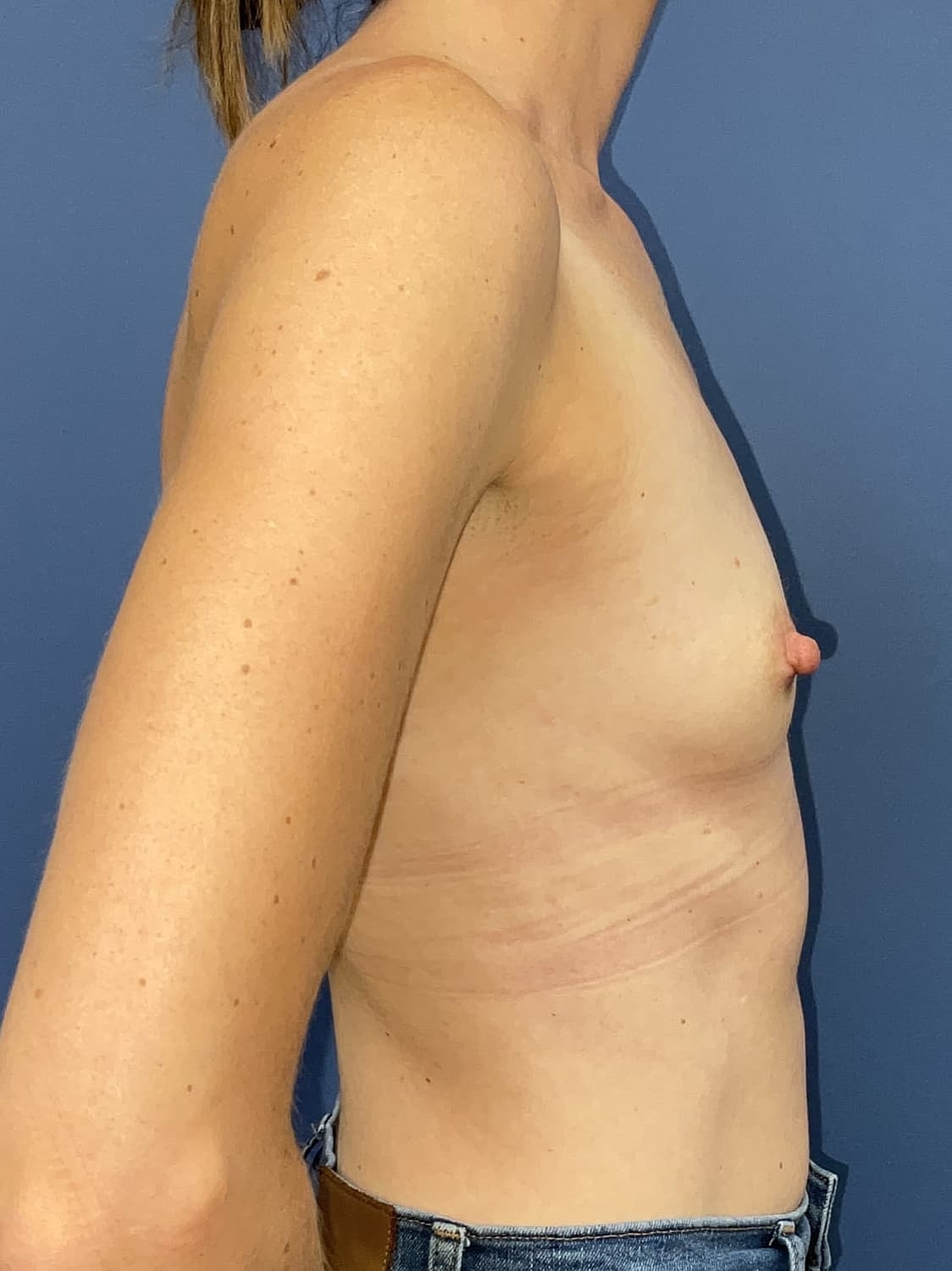 Breast Augmentation Before & After