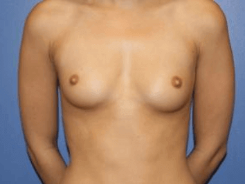 Breast Augmentation Before & After