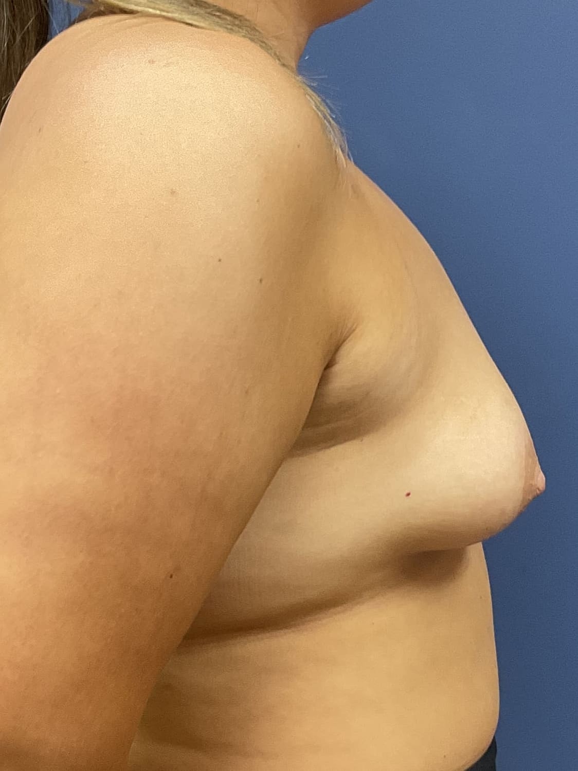 Breast Augmentation Before & After
