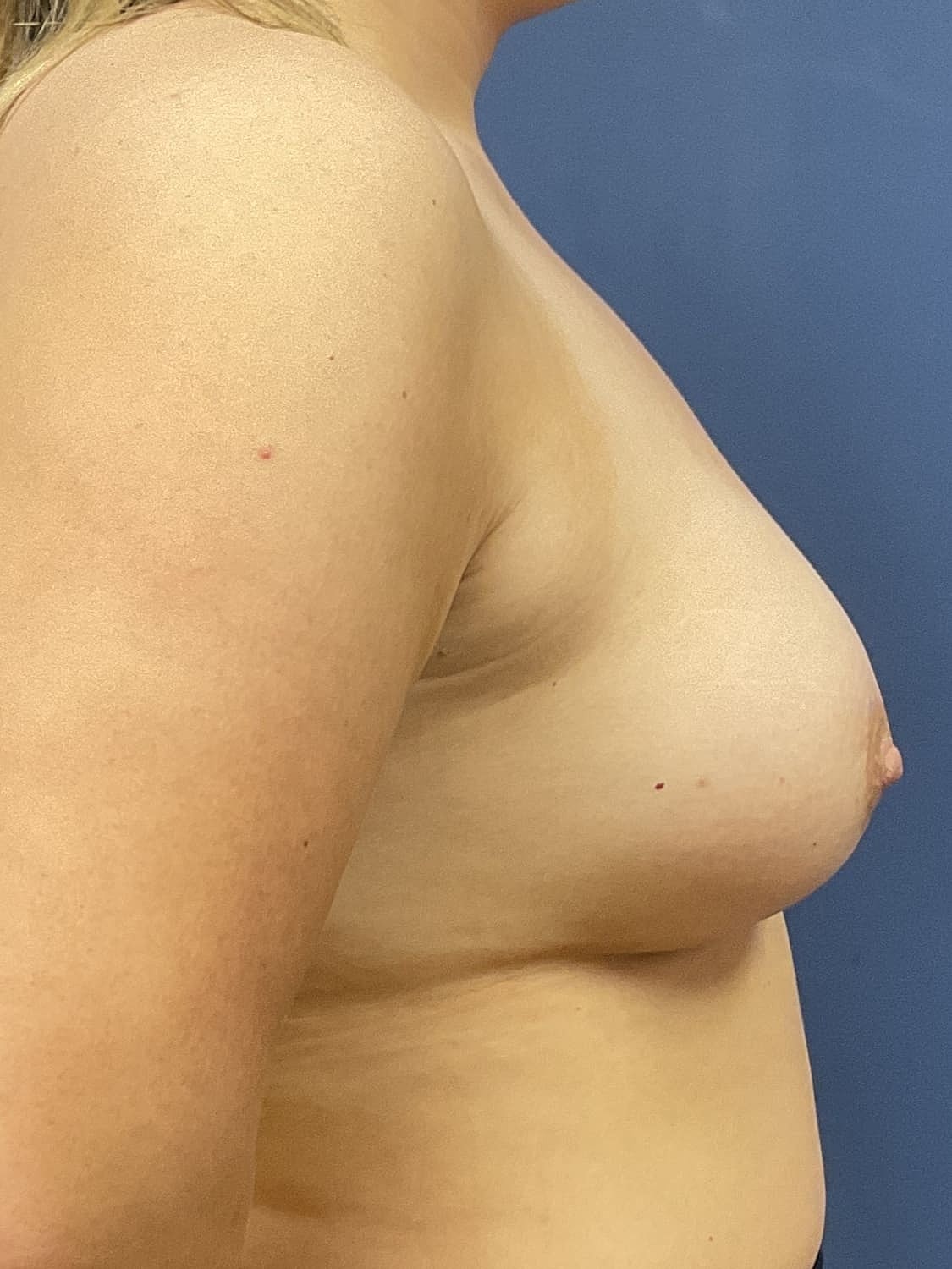 Breast Augmentation Before & After