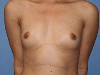 Breast Augmentation Before & After