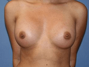 Breast Augmentation Before & After