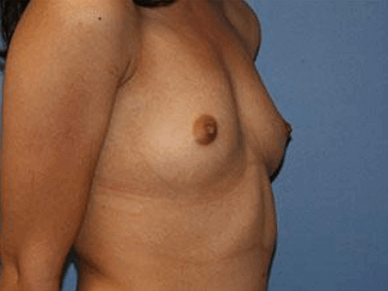 Breast Augmentation Before & After