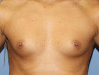 Breast Augmentation Before & After
