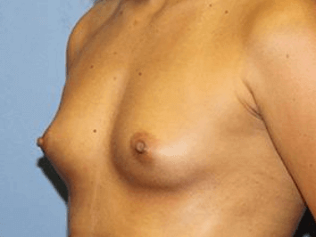 Breast Augmentation Before & After