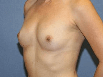 Breast Augmentation Before & After