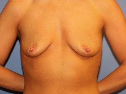 Breast Augmentation Before & After