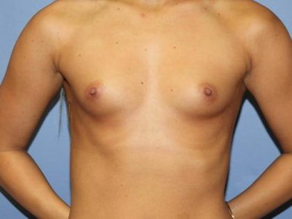 Breast Augmentation Before & After