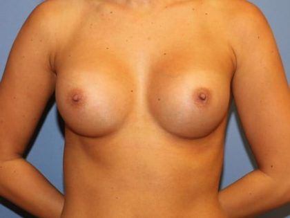 Breast Augmentation Before & After