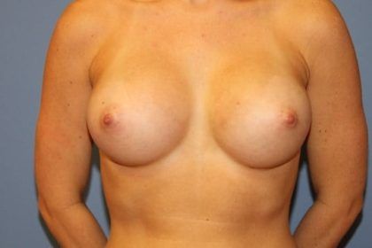 Breast Augmentation Before & After