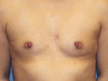 Breast Augmentation Before & After