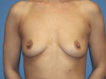 Breast Augmentation Before & After