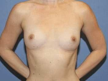 Breast Augmentation Before & After
