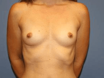 Breast Augmentation Before & After