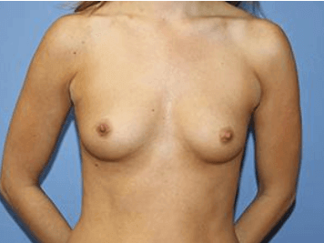 Breast Augmentation Before & After