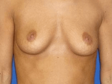 Breast Augmentation Before & After