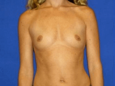 Breast Augmentation Before & After