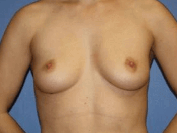 Breast Augmentation Before & After