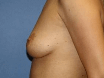 Breast Augmentation Before & After