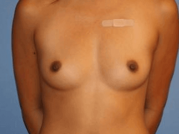 Breast Augmentation Before & After