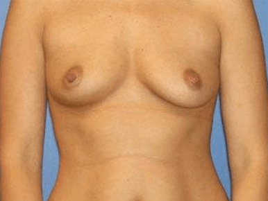 Breast Augmentation Before & After