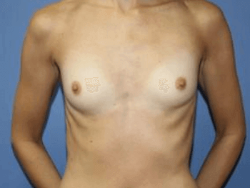 Breast Augmentation Before & After