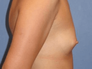 Breast Augmentation Before & After