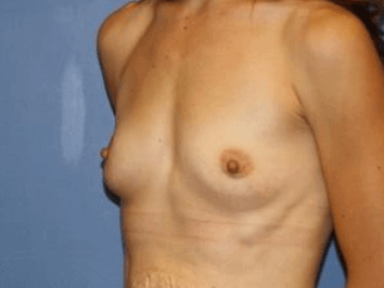 Breast Augmentation Before & After