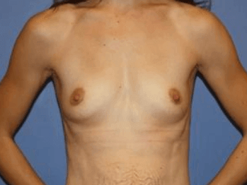 Breast Augmentation Before & After