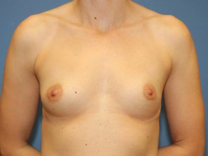 Breast Augmentation Before & After