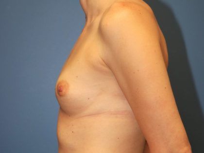 Breast Augmentation Before & After