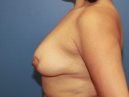 Breast Augmentation Before & After