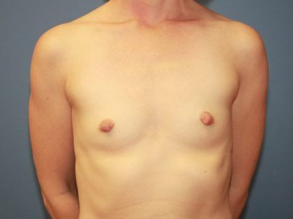 Breast Augmentation Before & After