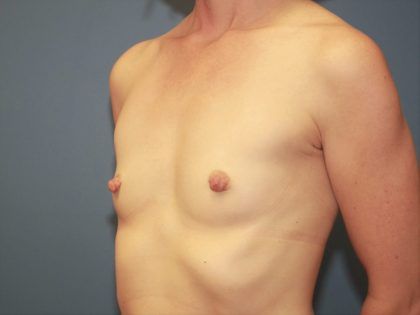 Breast Augmentation Before & After