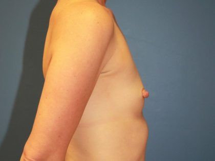 Breast Augmentation Before & After