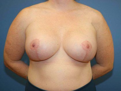 Breast Augmentation Before & After