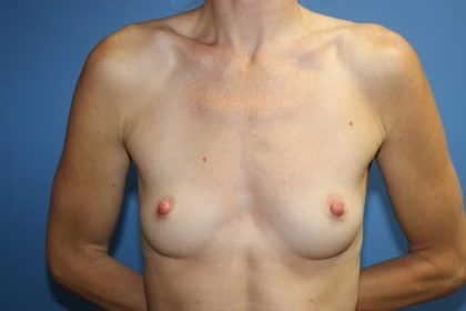 Breast Augmentation Before & After
