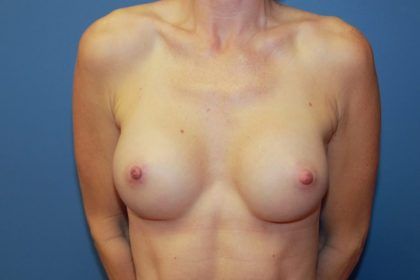 Breast Augmentation Before & After