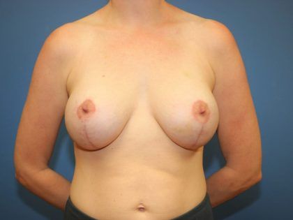 Breast Augmentation Before & After