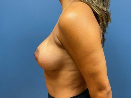Breast Augmentation Before & After