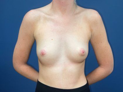 Breast Augmentation Before & After