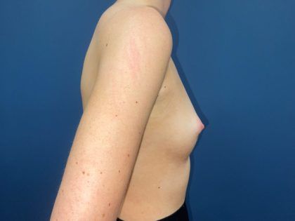 Breast Augmentation Before & After